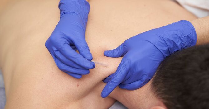 Dry Needling for Athletes: Faster Recovery and Improved Performance